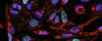 Immunofluorescence light microscopy image of cancer cells growing in 2D with nuclei in blue, cytoplasm in red, and DNA damage foci in green.