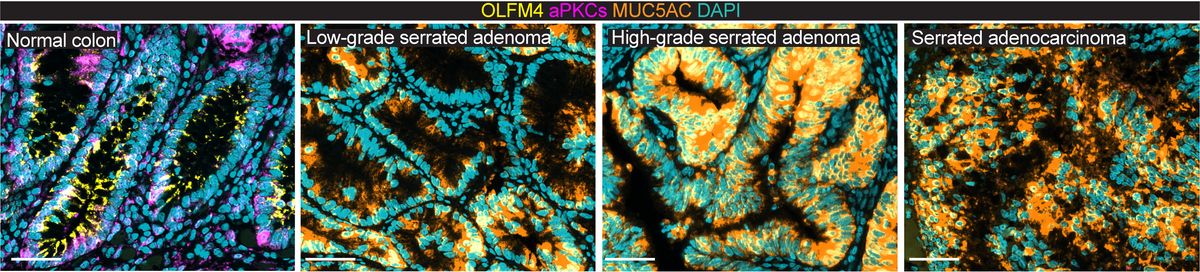 A four-panel image showing cells of a healthy intestinal mucosa (panel 1), premalignant adenoma gradually developing into a cancerous tumor (panel 2-4).