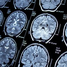 Multiple panels of a magnetic resonance imaging brain scan.