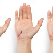 Three images of a hand with an abrasion progressing from most recently injured (left) to most healed (right).