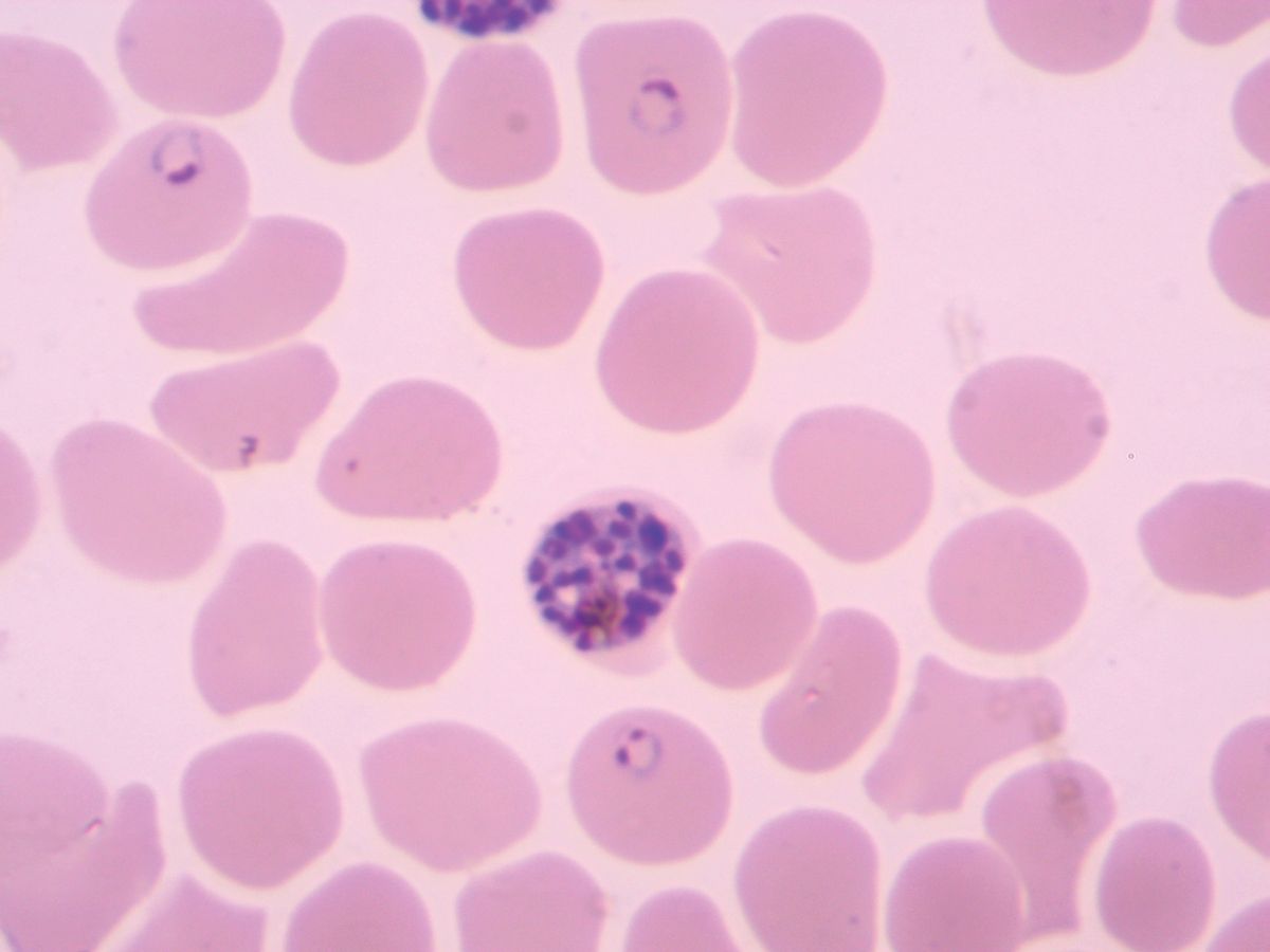 Red blood cells infected with Plasmodium falciparum parasites.