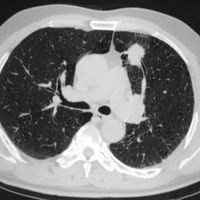 a CT scan of lungs