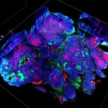 Histological stain of in blue, red, and green of tumor