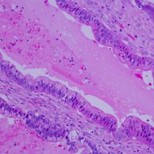 A stained tissue sample of metastatic pancreatic cancer