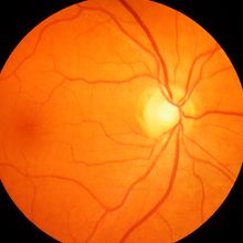 Light shines through a dilated pupil to illuminate the light red retina, blood vessels, optic disc and macula.