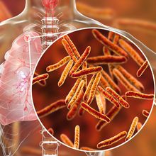 Illustration showing rod-shaped Mycobacterium tuberculosis bacteria in the lungs of a person with tuberculosis