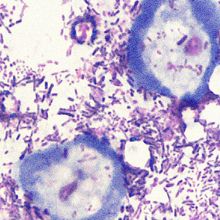 Image of a culture of <em >Entamoeba gingivalis</em> growing together with bacteria. There are two roundish amoeba cells surrounded by bacilli and other bacterial forms.