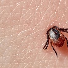 A tick embedded into skin.&nbsp;