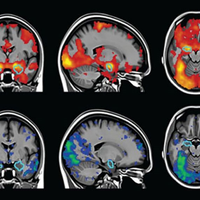 A series of brain scans on a black background