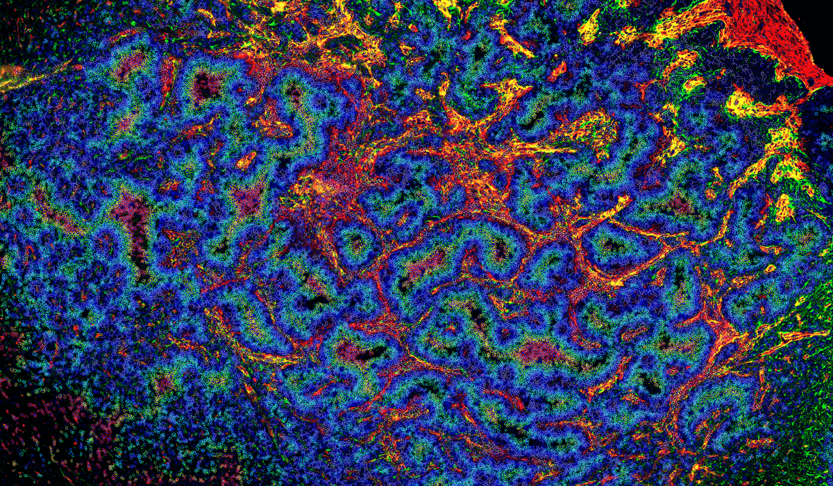 A colorful micrograph showing a glioblastoma, with areas of necrosis, infiltrating immune cells, and vascularization. 