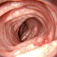 polyp colorectal cancer