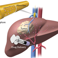 removing chemotherapy drugs infographic