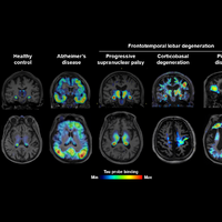 tau pet scan tracer tauopathy alzheimer's disease progressive supranuclear palsy corticobasal degeneration pick's disease frontotemporal lobal degeneration ftd alzheimer's disease neurodegeneration